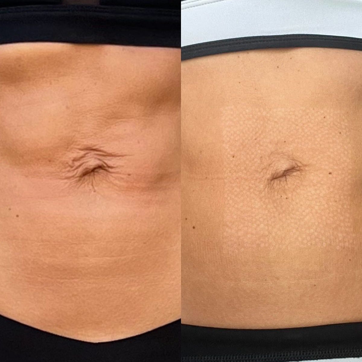Two Images of a Torso, Before and After — Vanity Skin and Beauty Forster in Forster, NSW