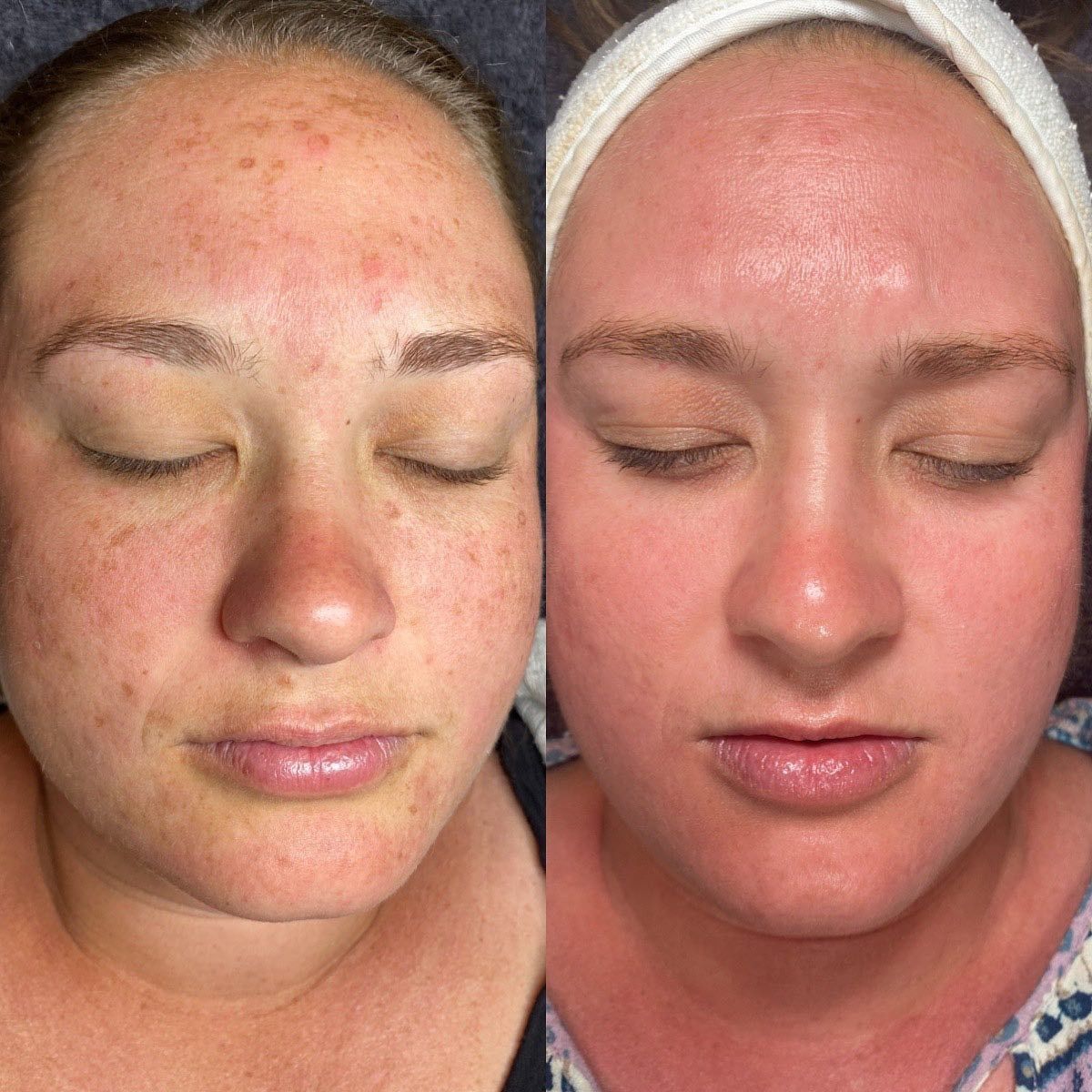 Before and After Facial Skin Comparison — Vanity Skin and Beauty Forster in Forster, NSW