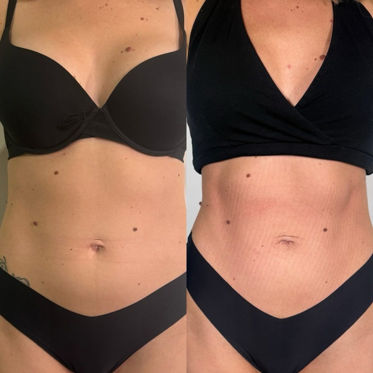 Side-by-side Comparison of a Person's Torso — Vanity Skin and Beauty Forster in Forster, NSW