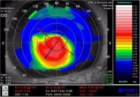 topografia della cornea