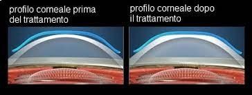 profilo corneale per lenti a contatto a Ferrara