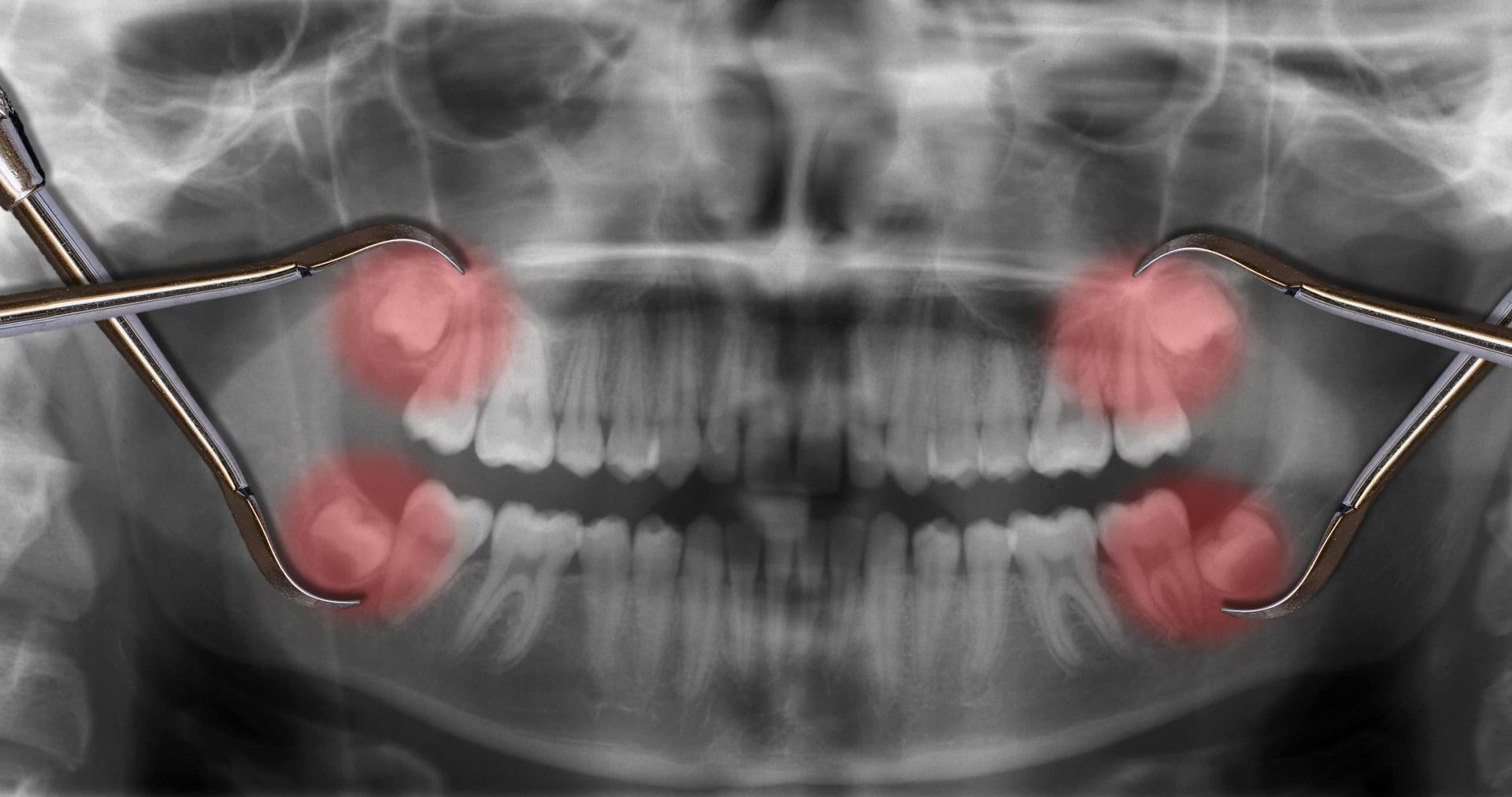 An x-ray of a person 's teeth with a toothache.