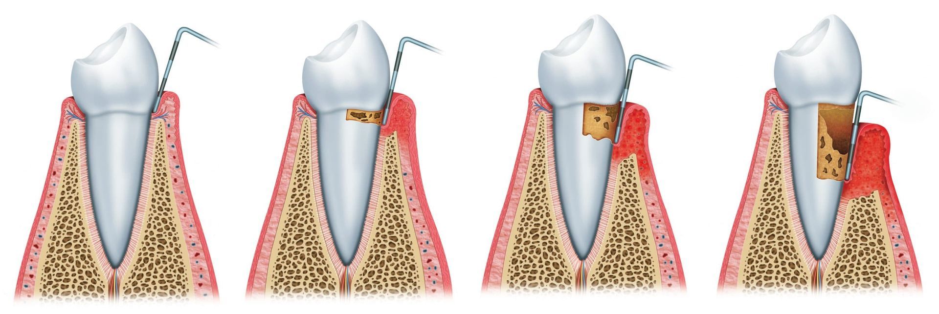 A diagram showing the stages of tooth decay