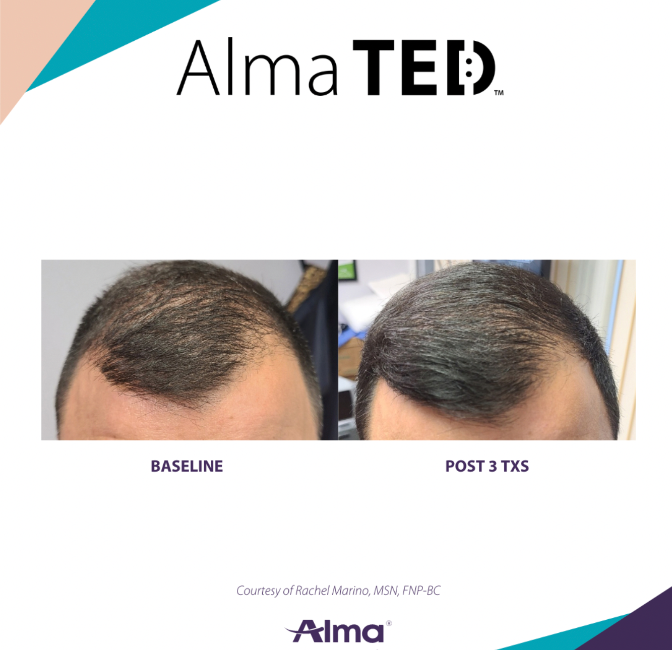 Alma Ted Before and After Results  of Men Sculp | Grandville, MI | Gentle Touch