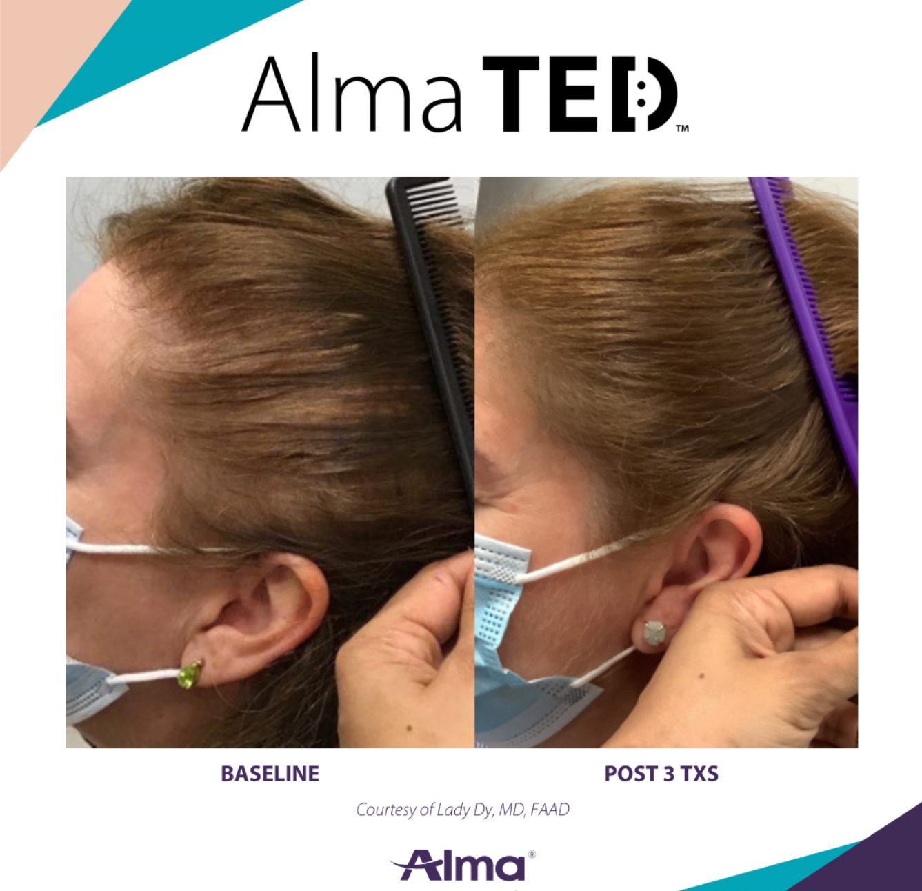 Alma Ted Before and After Results  of Women Sculp | Grandville, MI | Gentle Touch