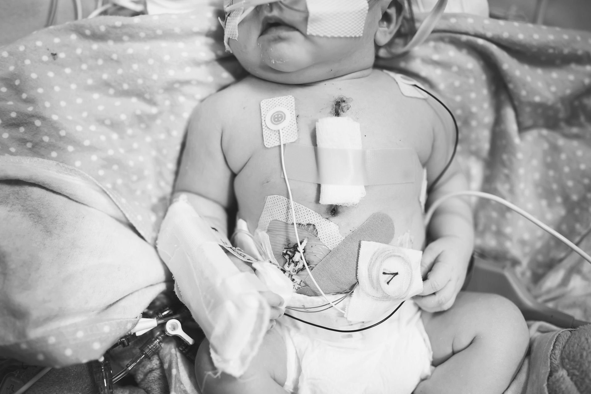 baby in the hospital with CHD world of broken hearts