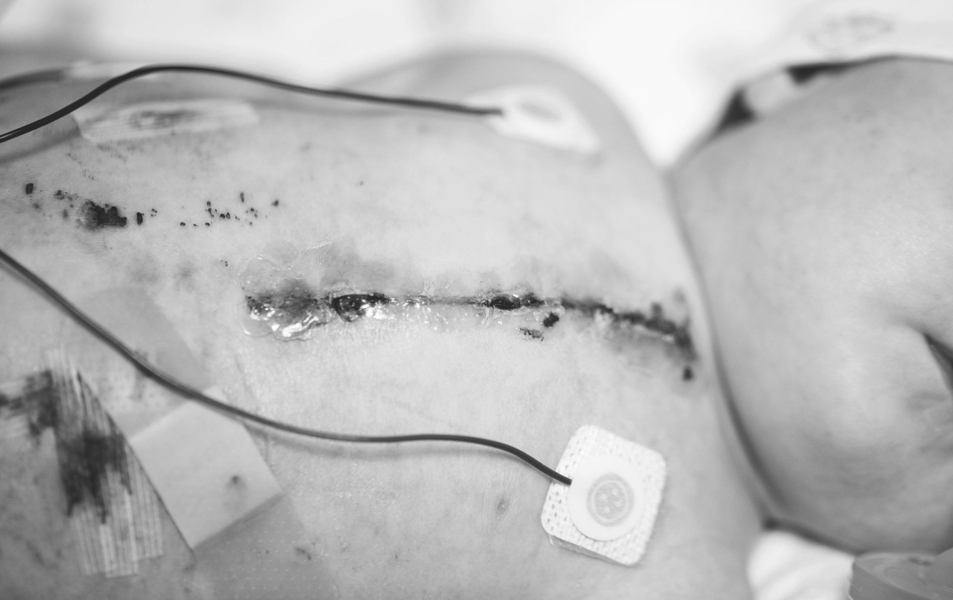 scars on childs chest