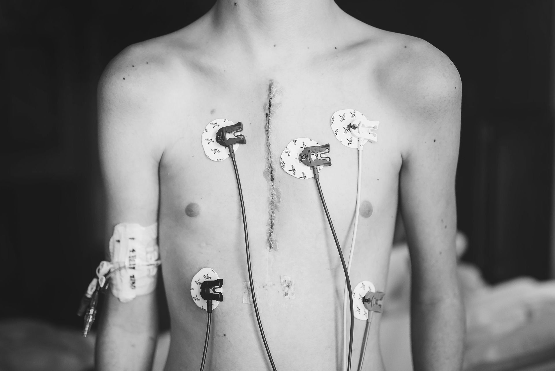 world of broken hearts types of congenital heart disease