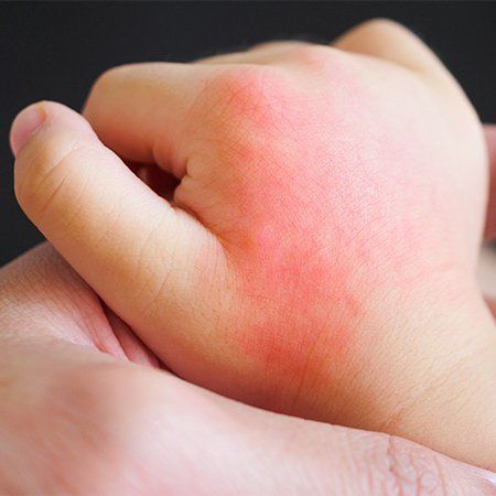 Baby Hand with Rashes — Jackson, MS — Capital City Children & Adolescent Clinic, PLLC