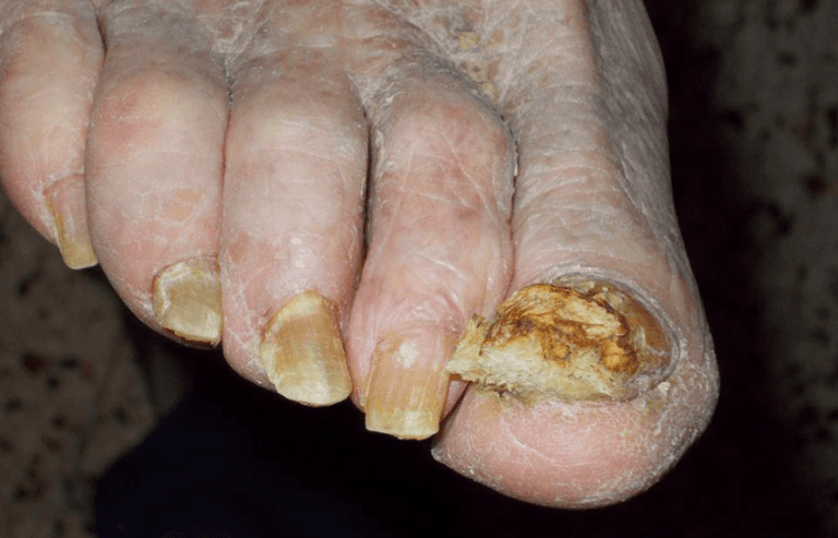 Piede con onicomicosi su tutte le unghie