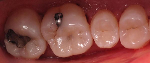 Dental Implants — Decayed Silver Fillings In Central Square, NY