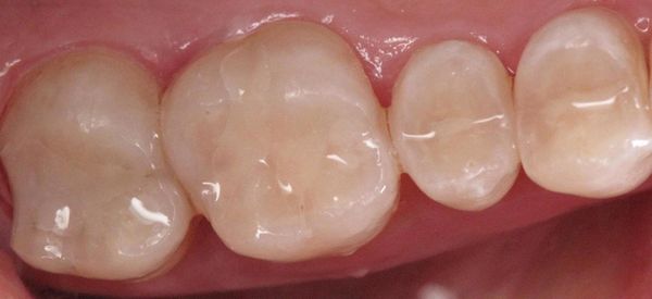 Dentures — Repaired Silver Fillings In Central Square, NY