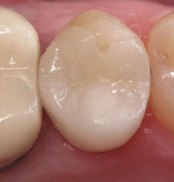 Veneers — Bonded And Colored Tooth In Central Square, NY
