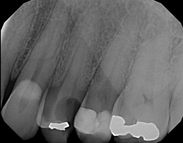 NY — X-ray of Tooth Needing Root Canal in Central Square, NY