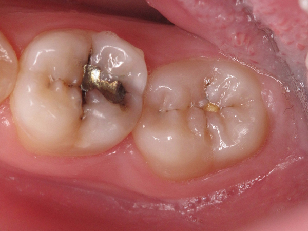 Extractions — Undermined Tooth Structure In Central Square, NY