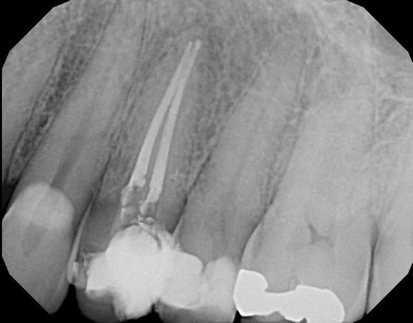 Central Square — X-ray Vision of Tooth in Central Square, NY