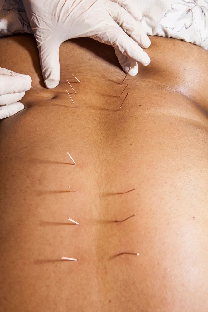 A person is getting acupuncture on their back.