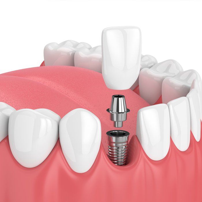 Implant restoration — Ashland and Ruther Glen, VA — Ashland Family Dentistry