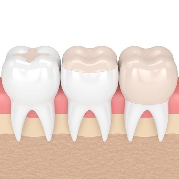 Process of teeth whitening — Ashland and Ruther Glen, VA — Ashland Family Dentistry