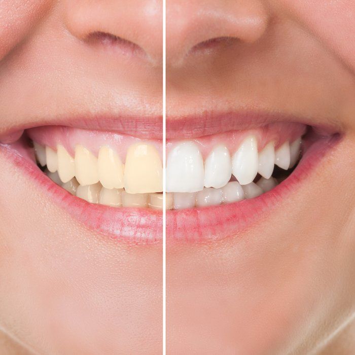Before and after teeth whitening — Ashland and Ruther Glen, VA — Ashland Family Dentistry