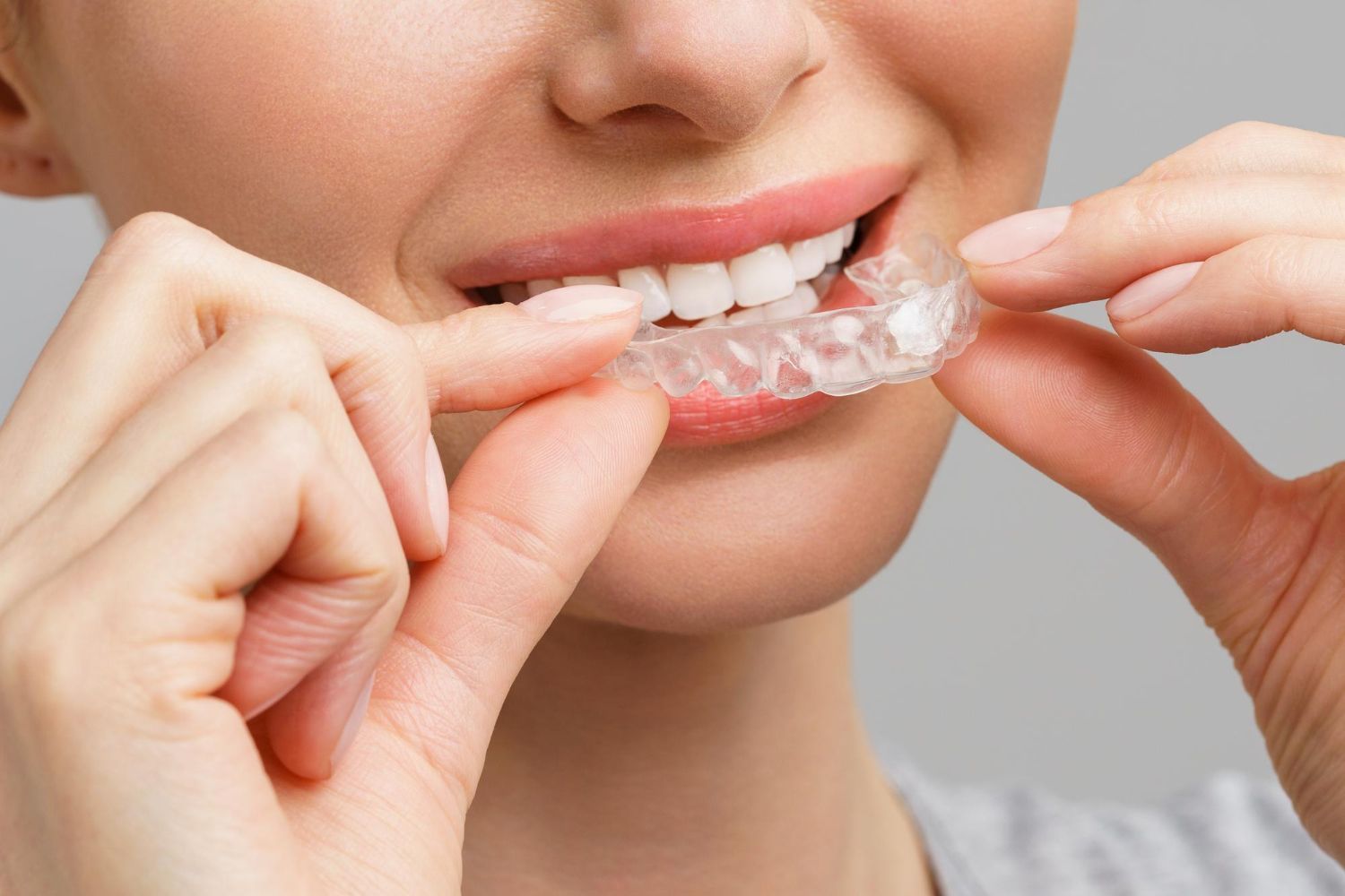 Invisalign treatment