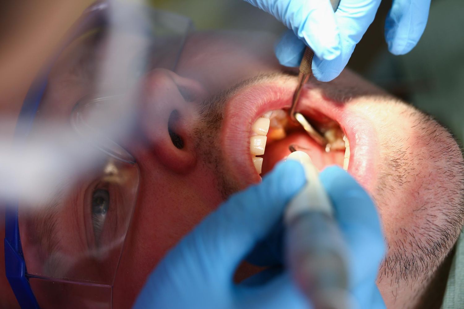 tooth extraction