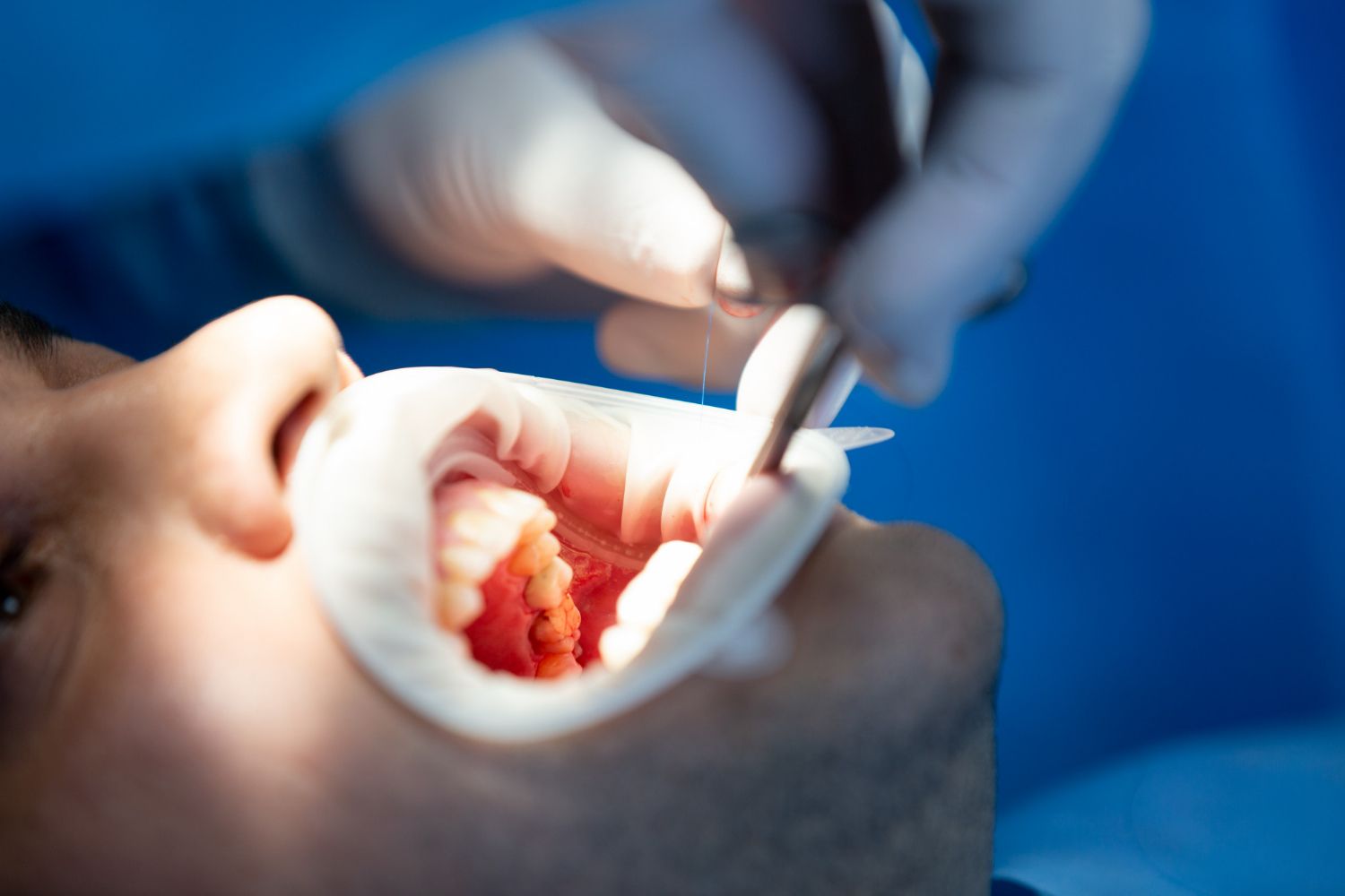 root canal