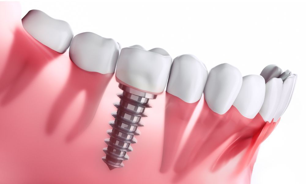 Indispensable Role of Dental Implants 
