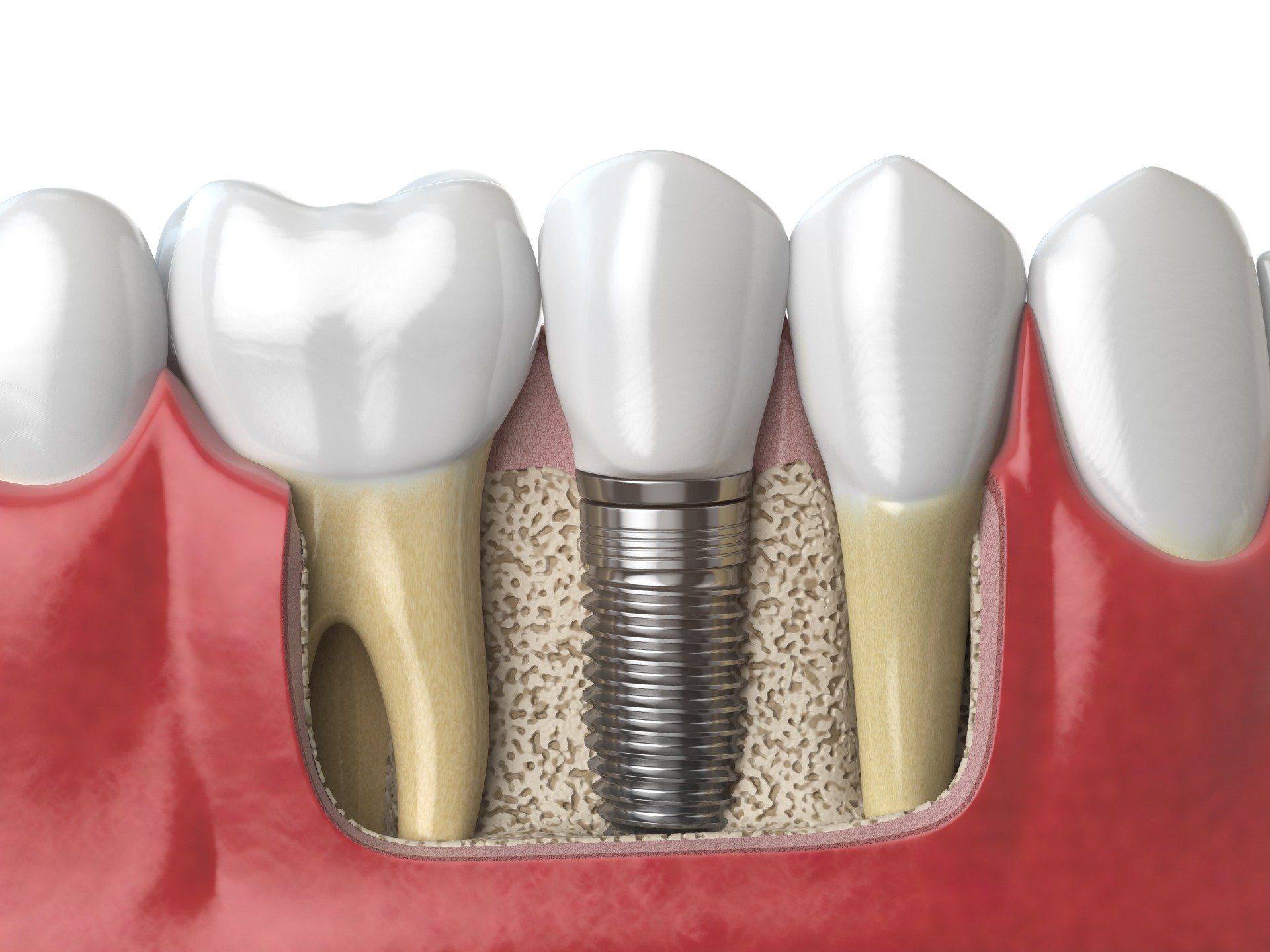 Top 10 Benefits of Dental Implants