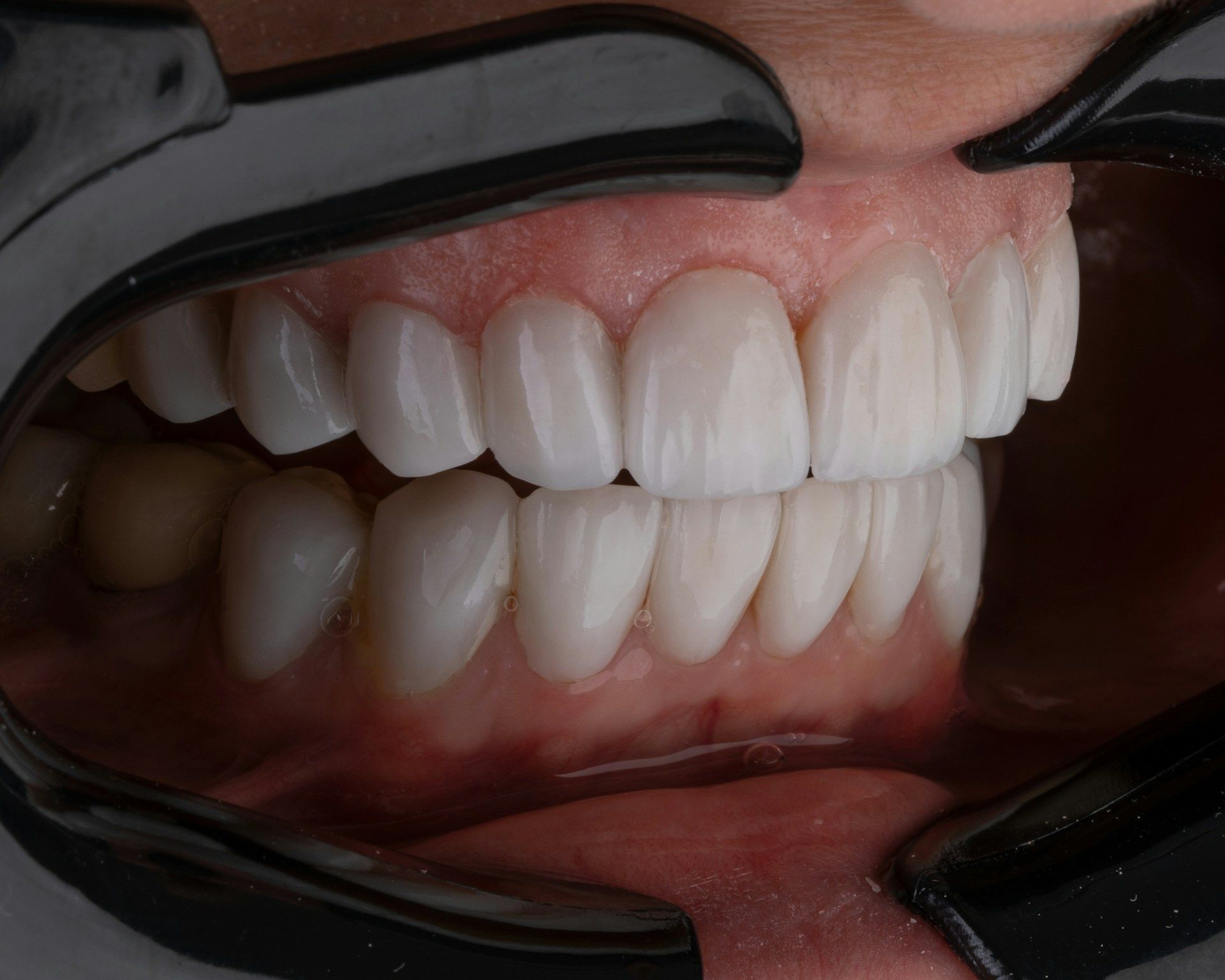 teeth whitening