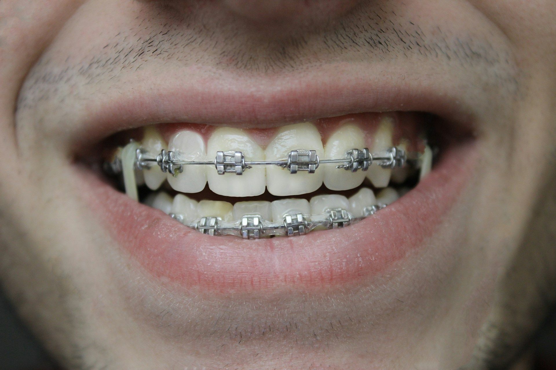 orthodontic treatments