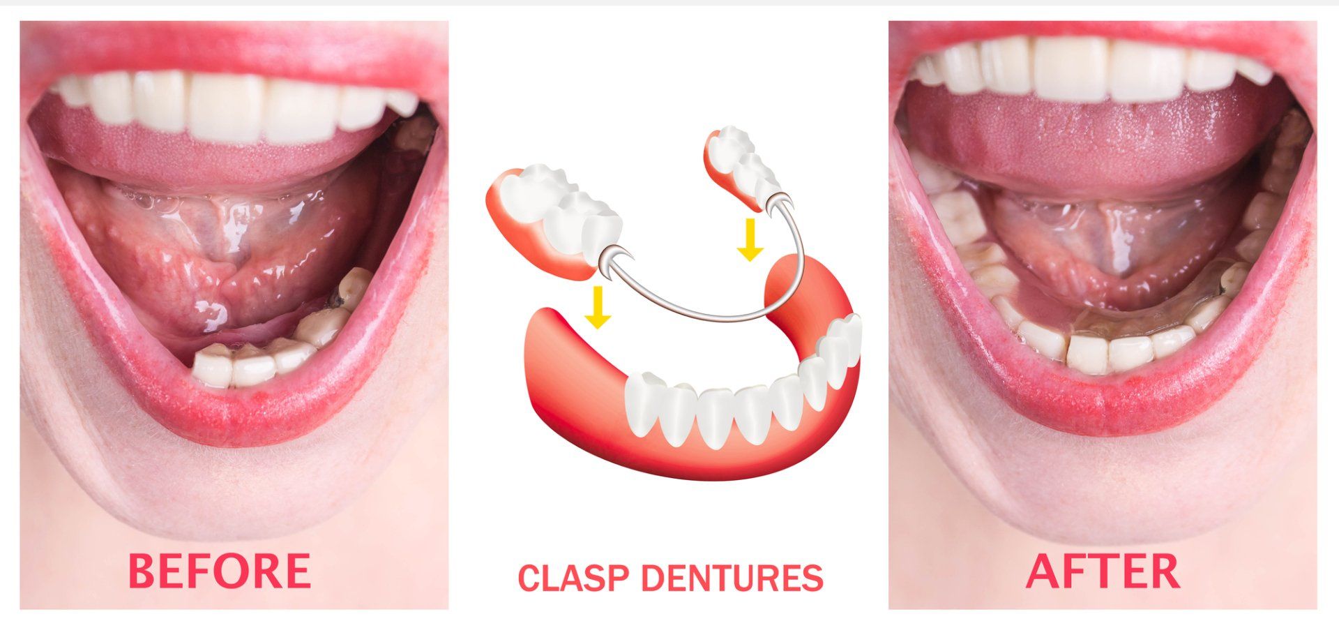 clasp dentures; a type of partial denture