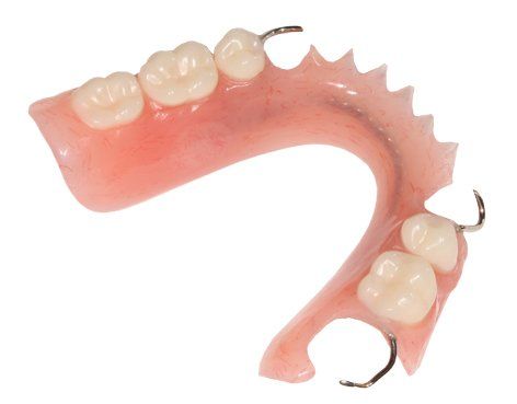 refurbished lower partial denture with metal clasping
