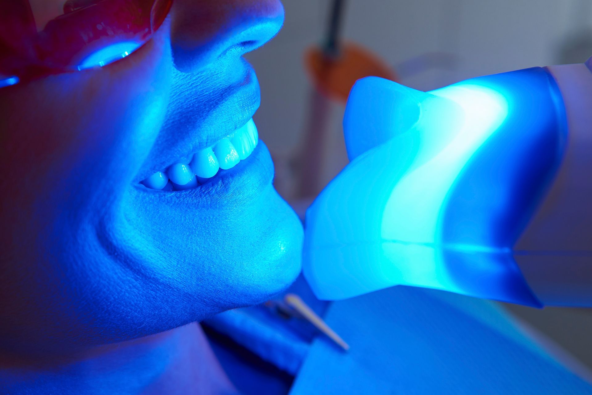 Person's smile lit by bright blue dental whitening light in a dentist's office. Person's smile lit by bright blue dental whitening light in a dentist's office.