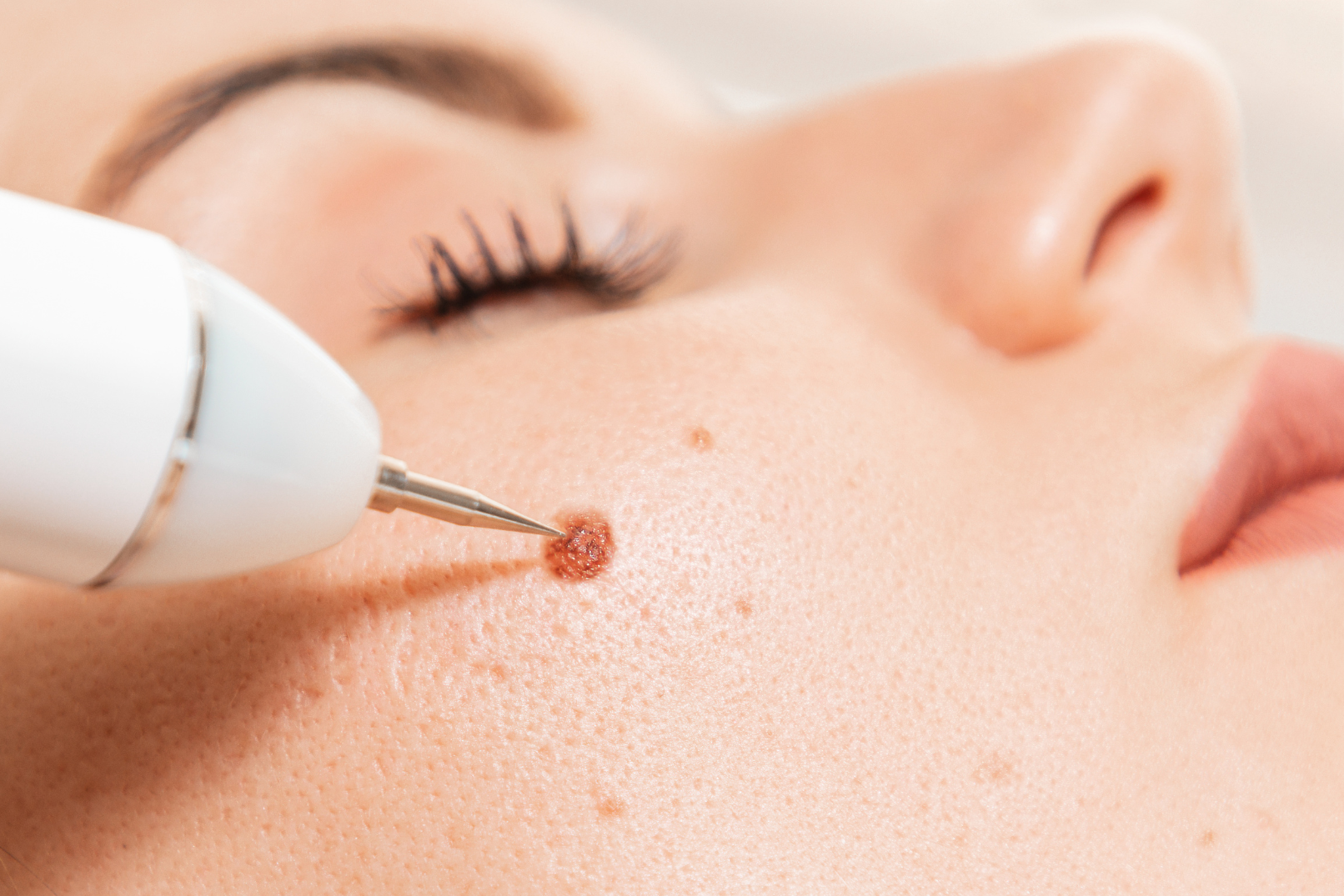 Close-up of a person's face with a skin tag being treated with a handheld device.