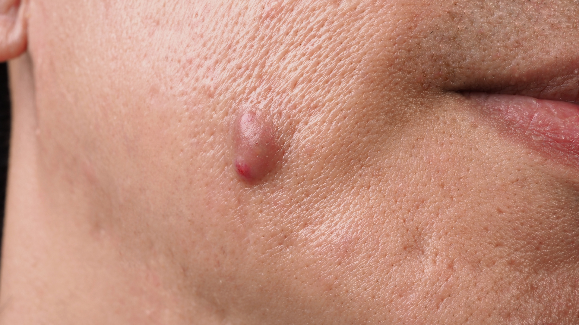 Close-up of a person's cheek with a raised, reddish-brown blemish.