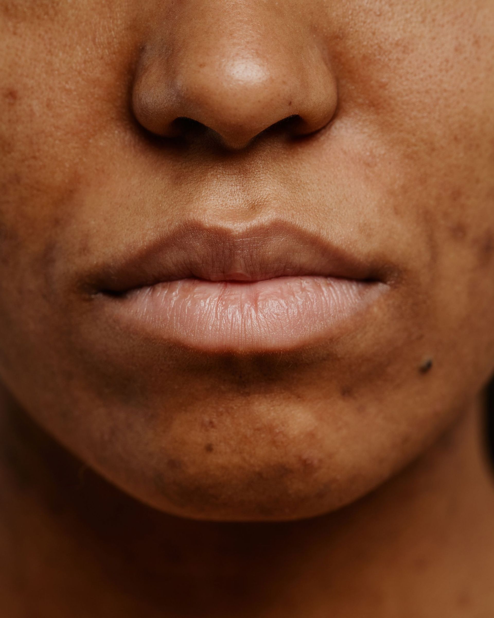 Close-up of a person's lower face. Skin is brown with dark spots. The lips are lightly colored.