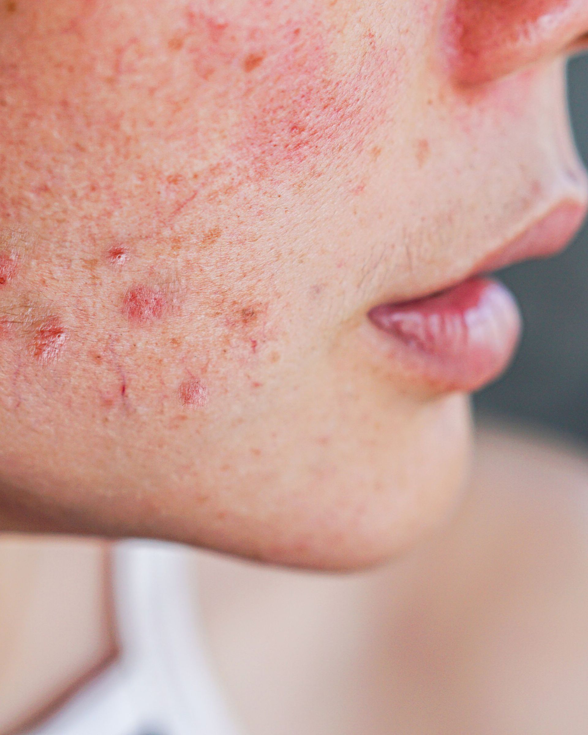 Close-up of a person's face showing skin with redness and pimples, suggesting acne.