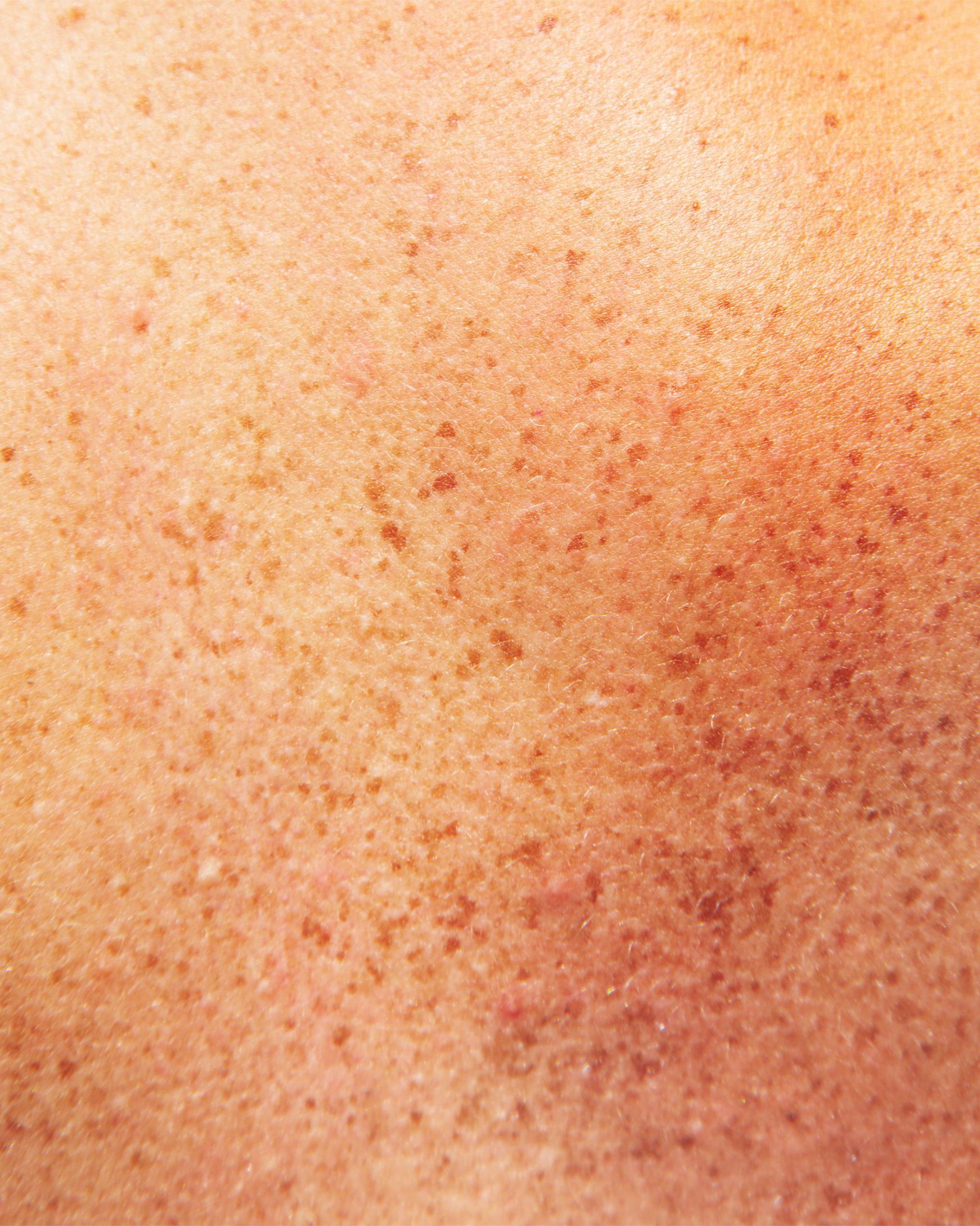 Close-up of human skin with many small, red-brown freckles and slight color variation.