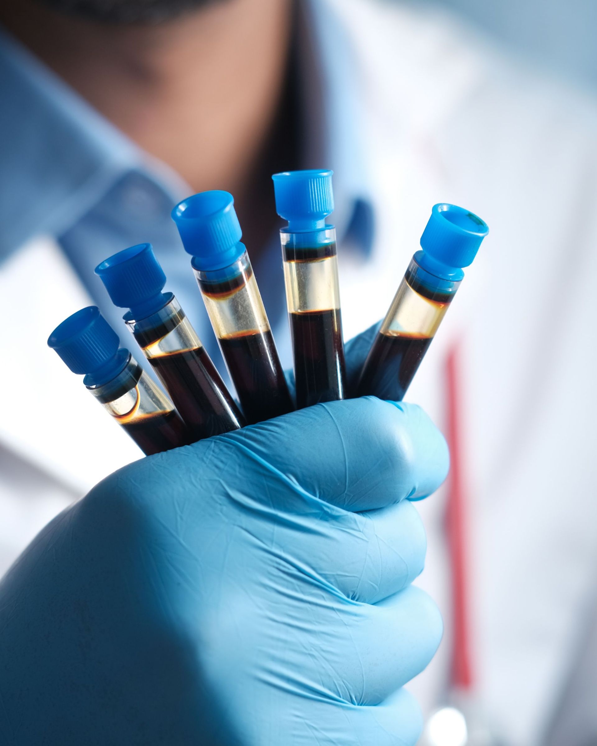 Gloved hand holding five vials of blood with blue caps.