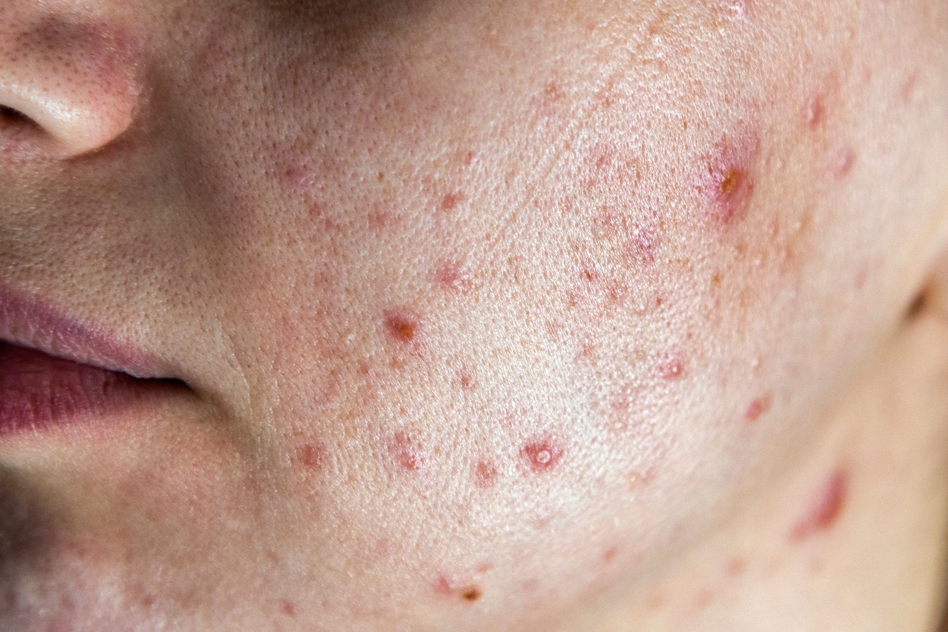 Close-up of a person's cheek with red, inflamed acne. Skin has small, raised bumps and discoloration.
