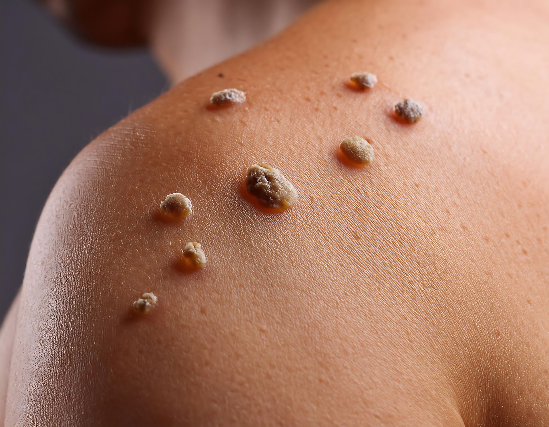 Skin with multiple, raised, tan-colored warts on the shoulder.