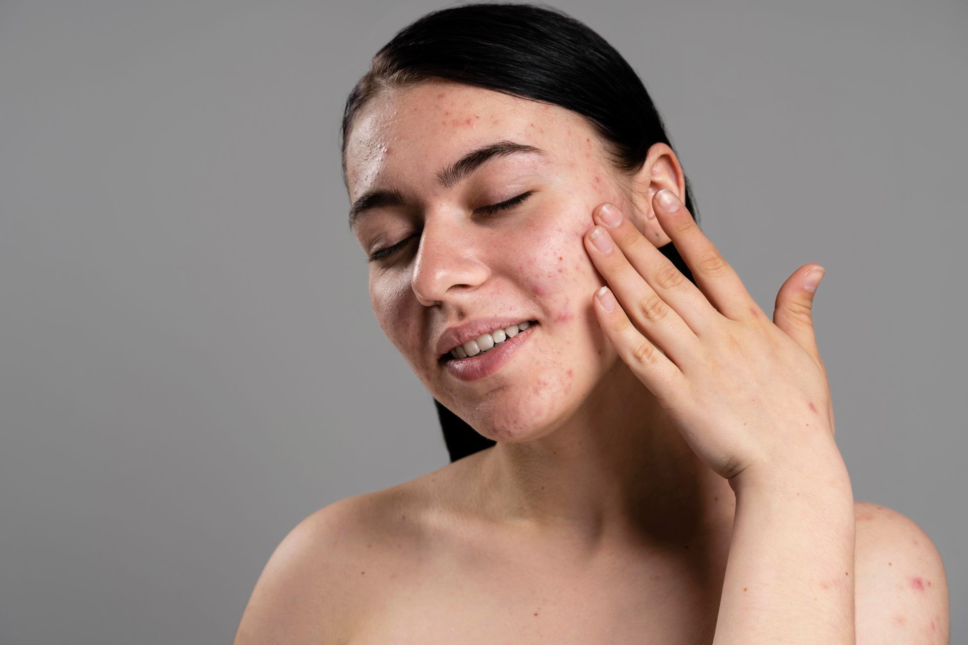 Woman with acne touches her face, eyes closed, against a gray background.