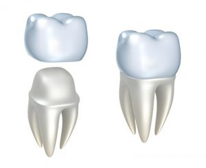 Dental Crowns — Mount Waverley, VIC — Mount Waverley Dental