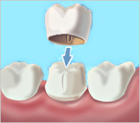 Covering Tooth — Mount Waverley, VIC — Mount Waverley Dental