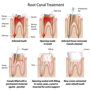 Root Canal Treatment Procedure — Mount Waverley, VIC — Mount Waverley Dental