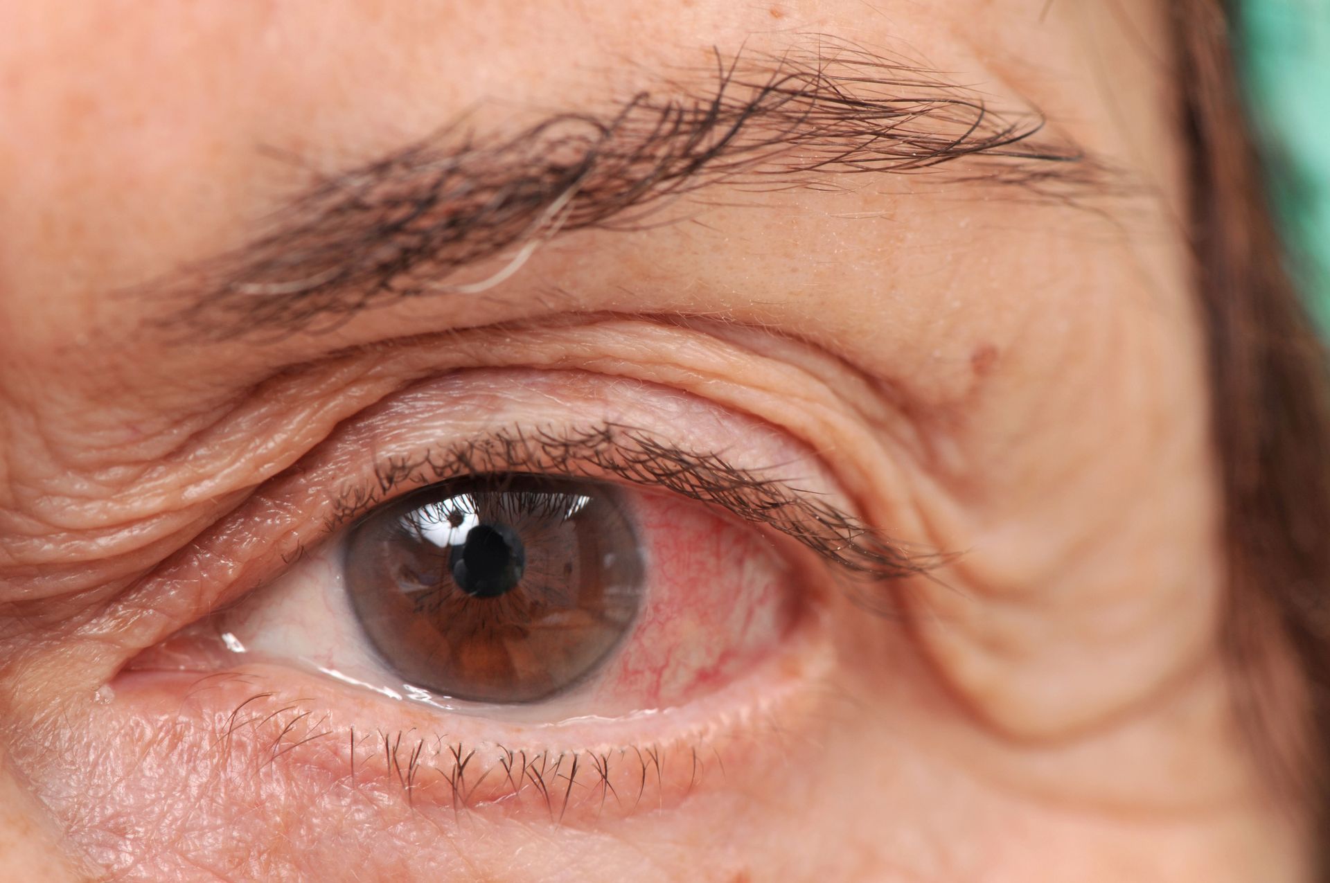 Close-up of a person's eye, showing redness, wrinkles, and brown iris.
