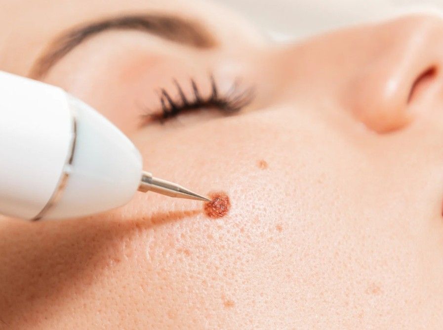 Laser Hair Removal Coventry providing hyperpigmentation, brown spot removal with a laser in Coventry clinic