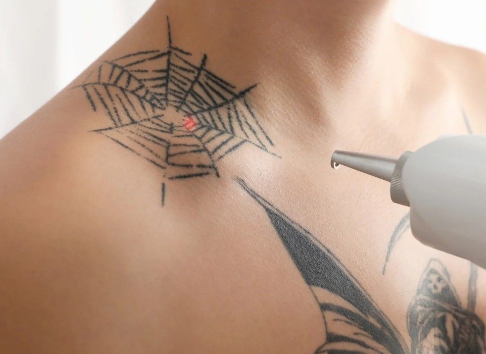 Laser tattoo removal for a client from Bannerbrook Park