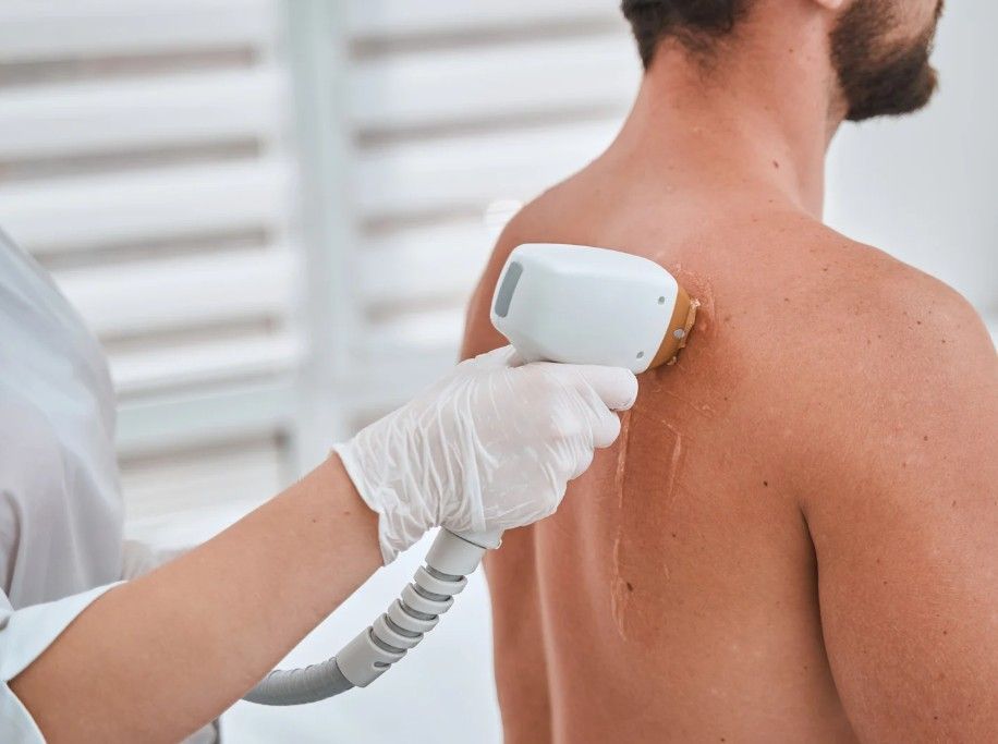 conducting laser hair removal from a man's back from Bannerbrook Park